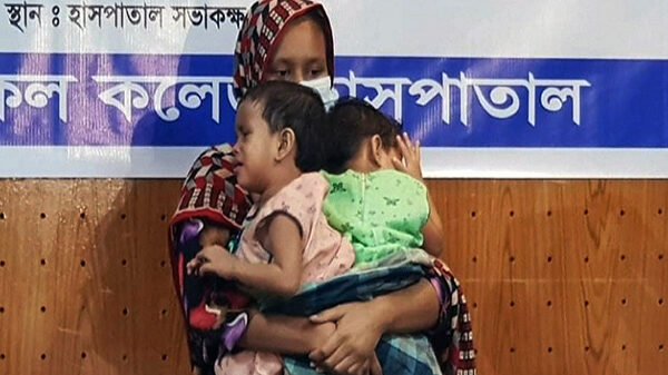 জোড়া শিশু লাবিবা-লামিসাকে আলাদা করতে চলছে অস্ত্রোপচার