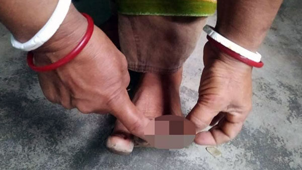 বন্যা কবলিত এলাকায় ছড়াচ্ছে পানিবাহিত রোগ